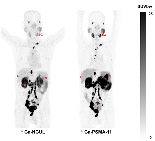 전이 전립선암 환자에게 PSMA-NGUL을 주입한 경우(좌)와 PSMA-11을 주입한 (우) 경우의 PET/CT 영상.   좌측 PSMA-NGUL의 경우 전립선암의 원발병소 (전립선), 임파절 전이병소, 뼈전이 병소가 뚜렷하고, 다른 장기들이 훨씬 흐리게 보여 보다 명확하게 진단할 수 있다.