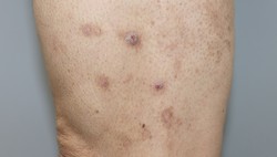 Nodular pruritus associated with chronic kidney disease