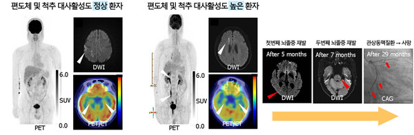 예후가 서로 다른 급성 뇌졸중 환자의 양전자 단층 촬영 검사 결과