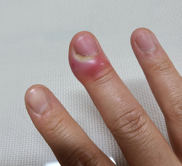 조갑주위염으로 손톱 주변이 부어오른 환자 사진