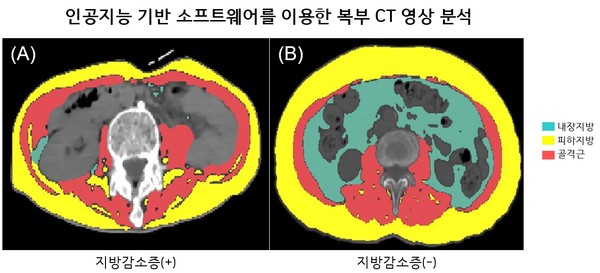 [사진] 인공지능 소프트웨어로 분석한 루게릭병 환자의 CT사진