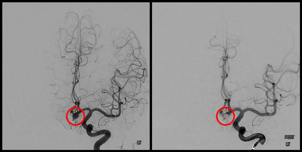 (좌)뇌혈관이 꽈리 모양으로 부푼 뇌동맥류 환자의 사진 / 코일 색전술 치료를 받은 뇌동맥류 환자의 사진