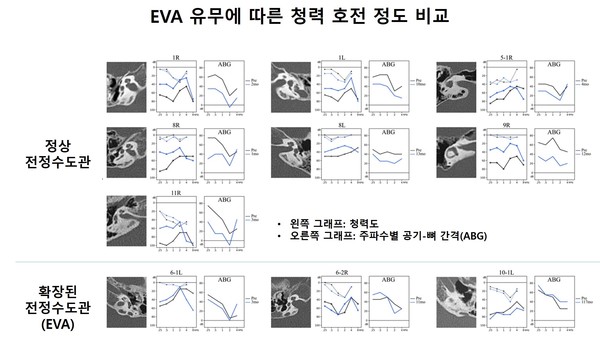 [그래프] 확장된 전정수도관(EVA) 유무에 따른 중이 수술 후 air-bone gap(ABG)을 통해 살펴본 청력 호전 정도에 대한 비교