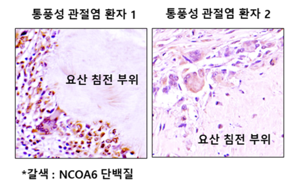 통풍성 관절염 환자의 병변부위에 핵수용체 활성보조인자 6(Nuclear receptor coactivator, NCOA6)의 발현이 증가되어 있음.