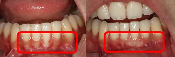 잇몸이식술을 통해 노출된 치근면을 덮기 전(왼쪽)과 치료 후 모습(오른쪽)