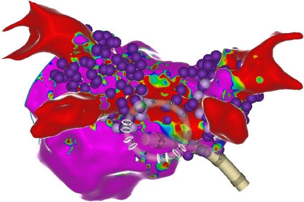 심방세동 환자의 좌심방 구조를 3차원으로 시각화한 이미지. 보라색 구체는 펄스장 절제술로 치료가 완료된 부위를 나타냄