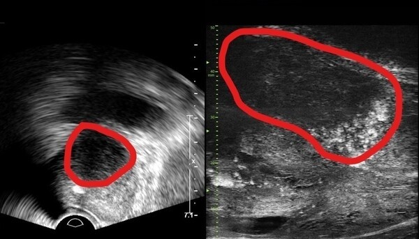사진= 기존 전립선 초음파 사진(좌) 및 최신 초음파 사진(우).